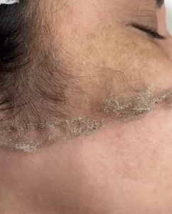 Read more about the article Does peach fuzz grow back thicker after dermaplaning?
