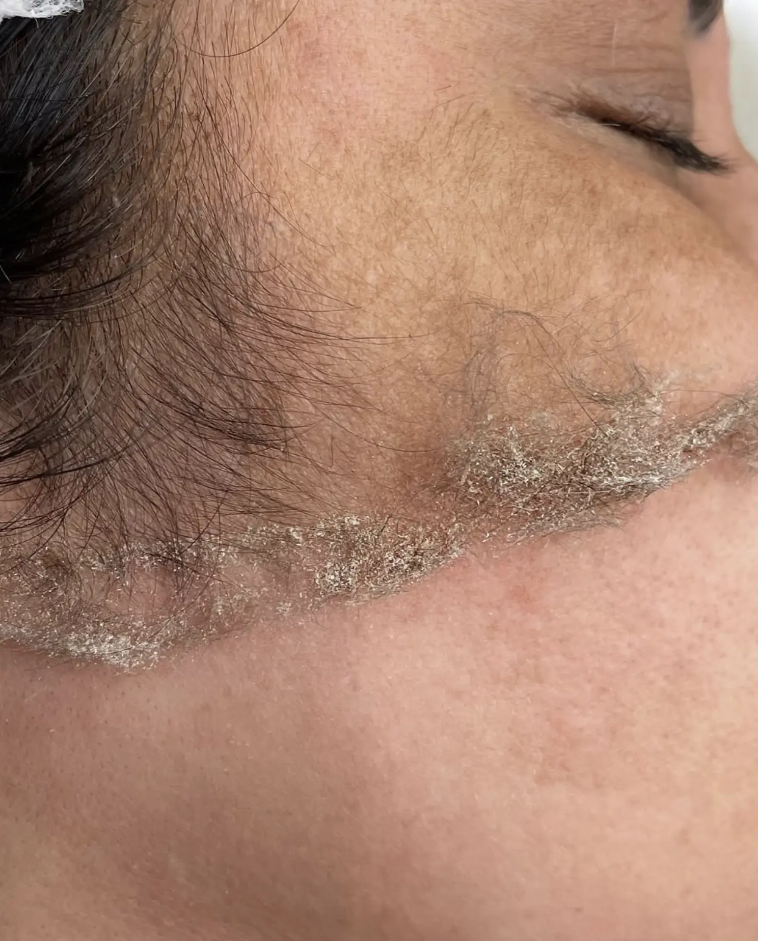 Read more about the article Does peach fuzz grow back thicker after dermaplaning?