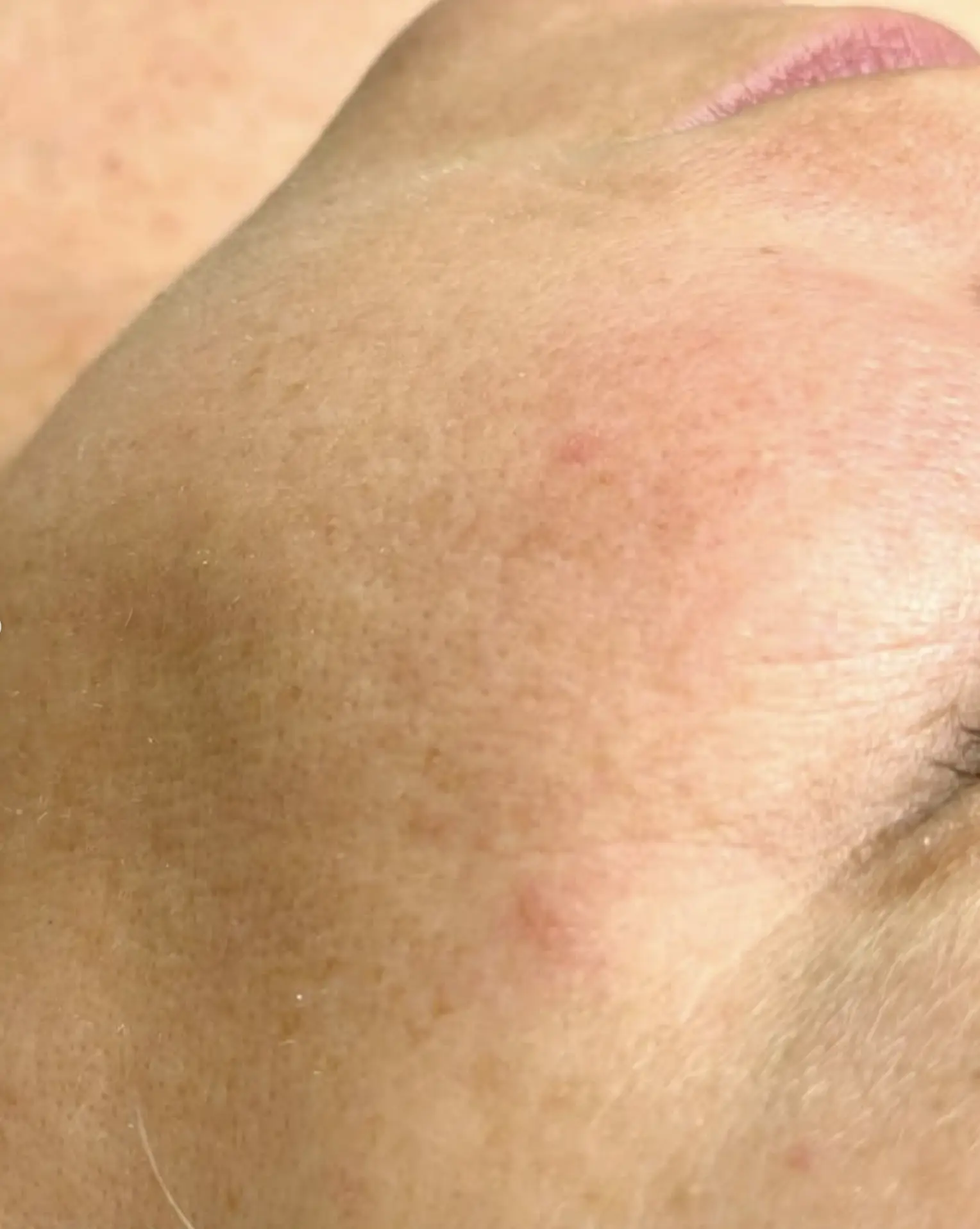 facial hair removal Brisbane