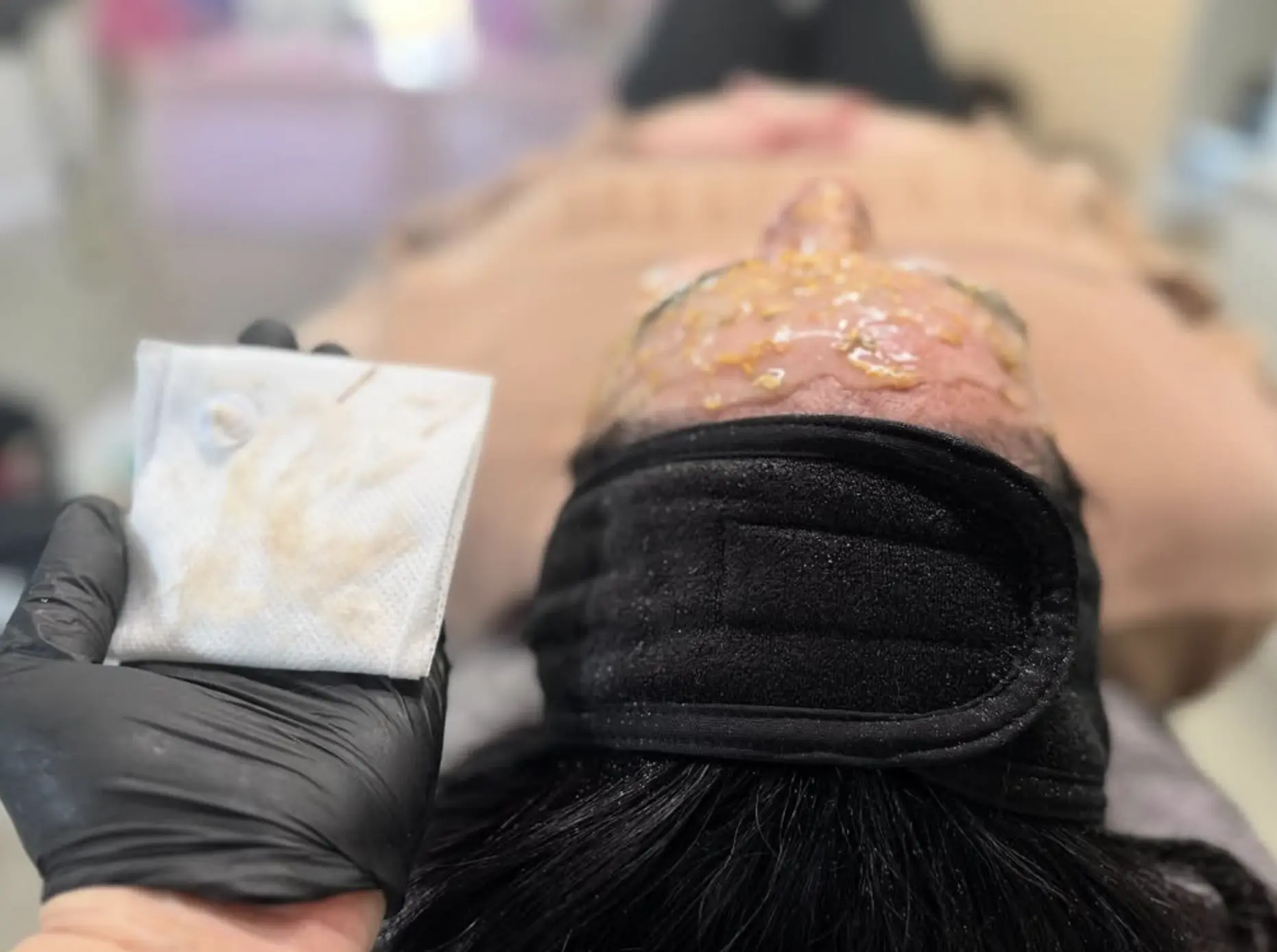 is dermaplaning safe