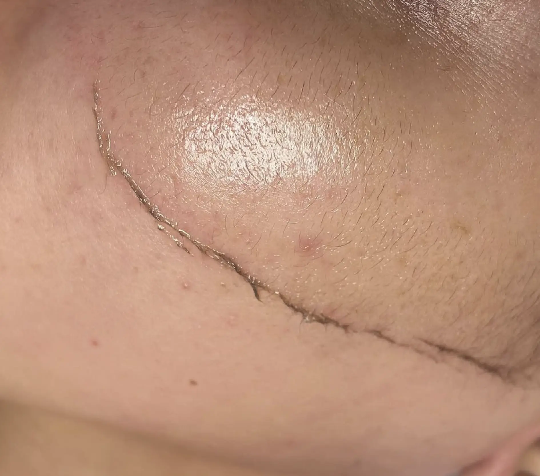 professional dermaplaning for peach fuzz