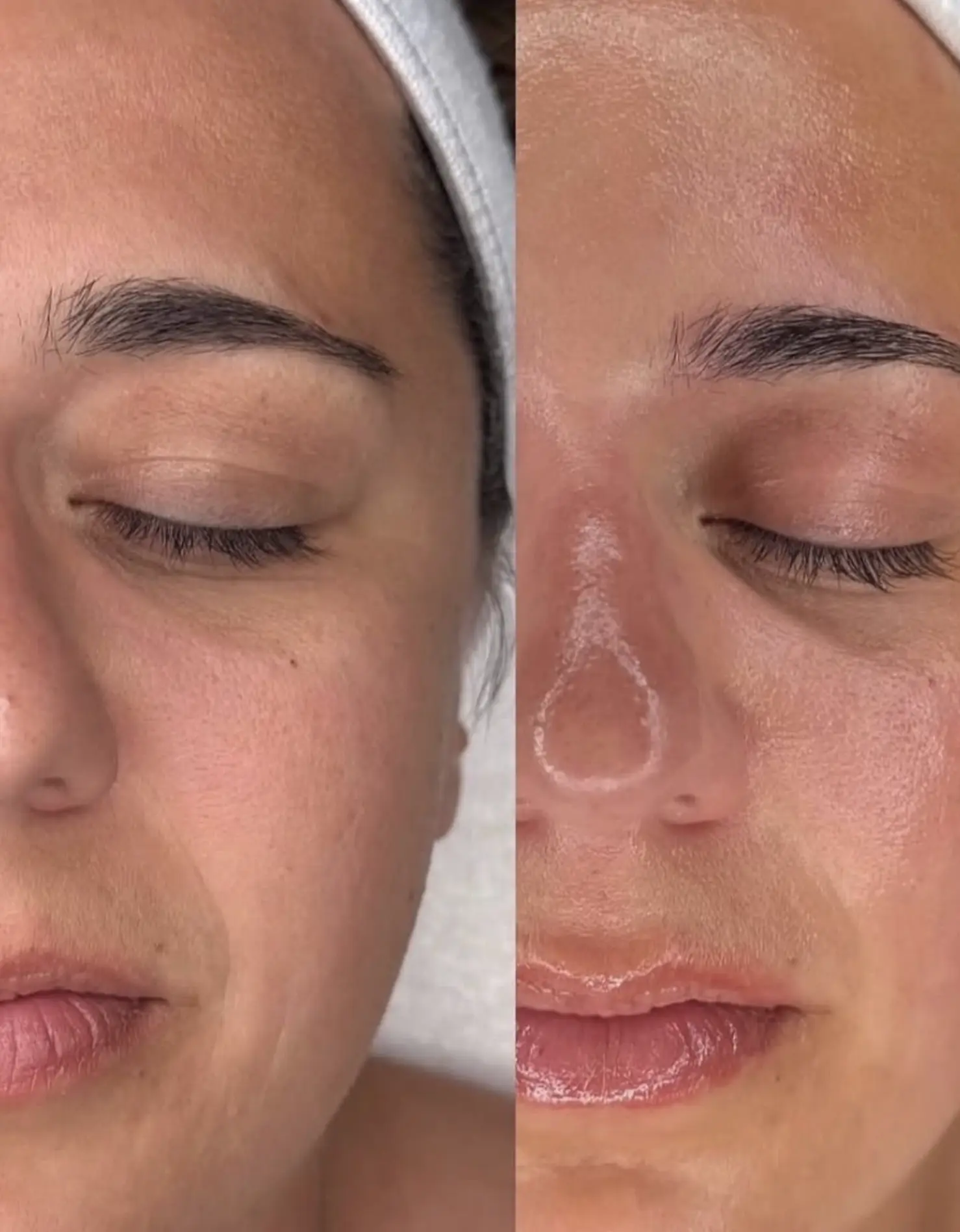 best hydrafacial in brisbane