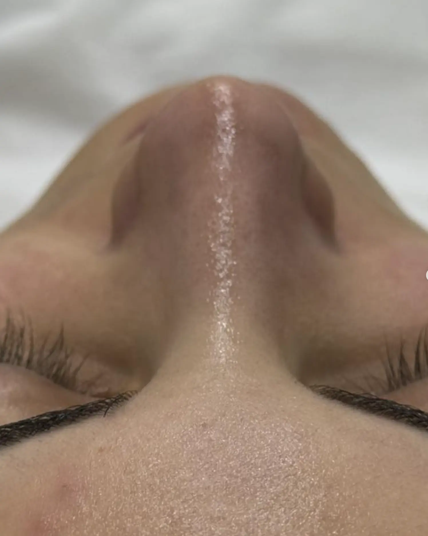 hydrafacial south brisbane